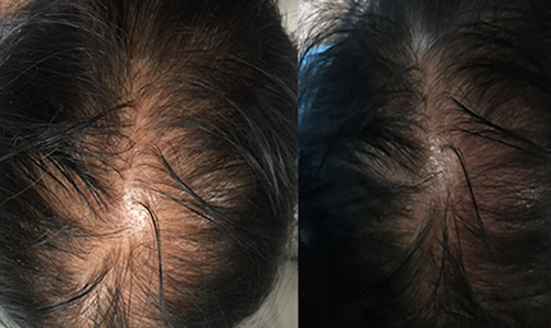 non surgical hair restoration results mississauga